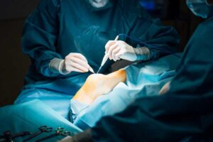 Plantar Fasciitis Surgery
